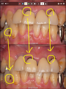フッ化物応用その他による、虫歯の進行抑制の例（40代男性）001