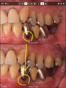 フッ化物応用その他による、虫歯の進行抑制の例（40代男性）002
