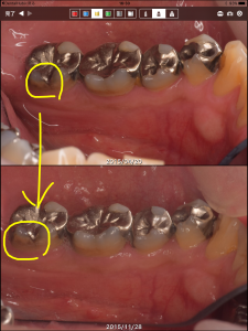 フッ化物応用その他による、虫歯の進行抑制の例（40代男性）003