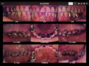 フッ化物応用その他による、虫歯の進行抑制の例（40代男性）006